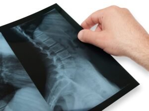 Radiografía lumbar donde se ven cambios óseos