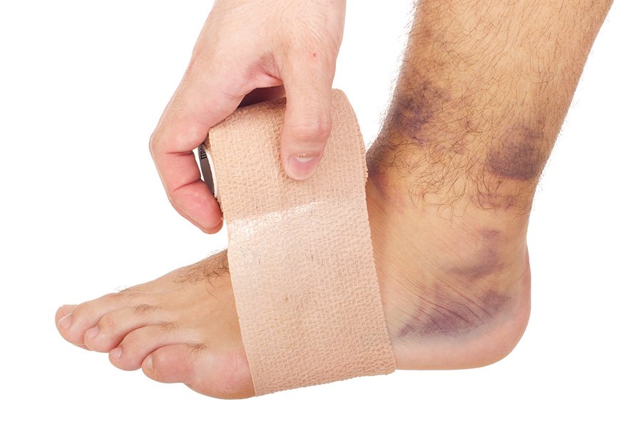 Esguince de tobillo con hematoma e hinchazón
